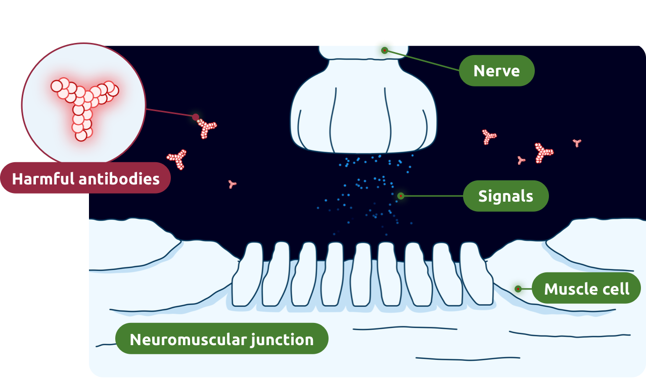 In gMG, harmful antibodies interrupt signaling at the neuromuscular junction.