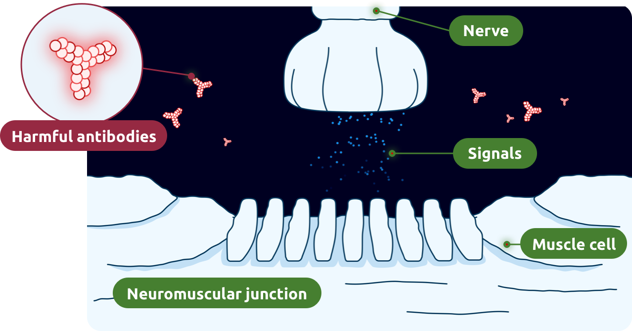 In gMG, harmful antibodies interrupt signaling at the neuromuscular junction.